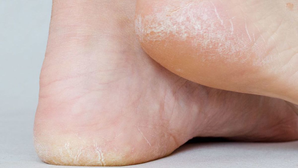 Everything You Should Know about Cracked Feet and How to Avoid Them