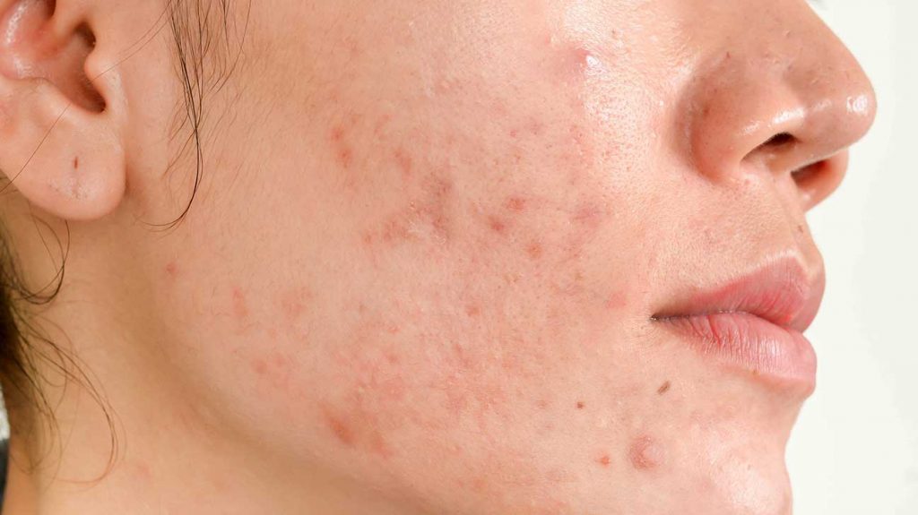 How To Get Rid of Acne Scars (Part 1)