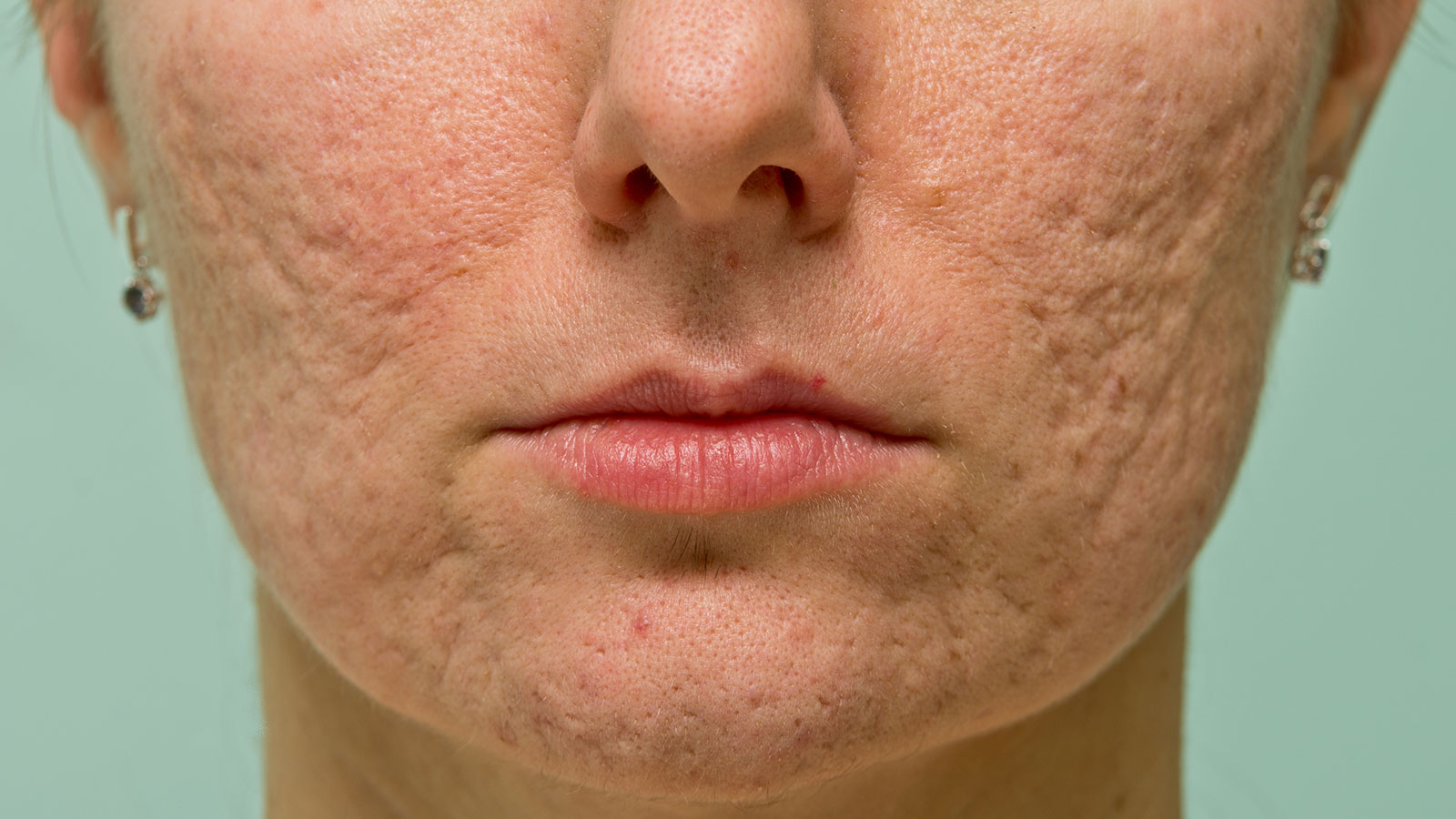 How To Get Rid of Acne Scars? (Part 2)