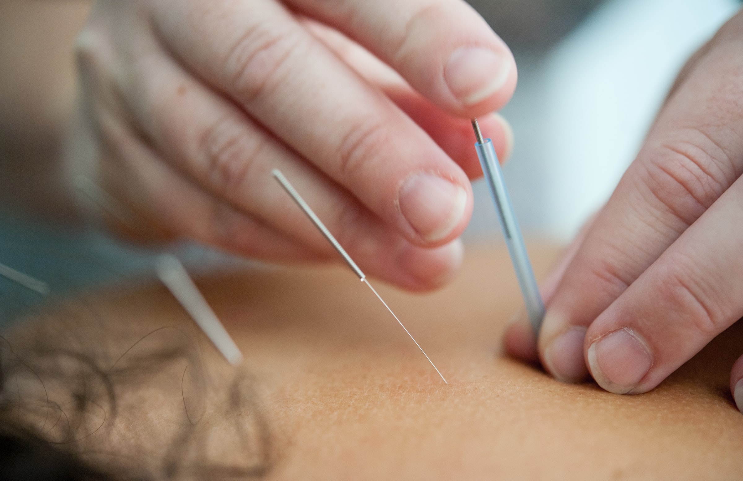 5 Things You Need To Known About Acupuncture