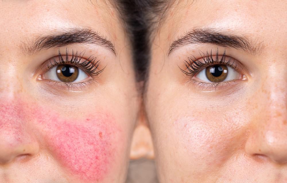 Let’s Talk About Facial Redness