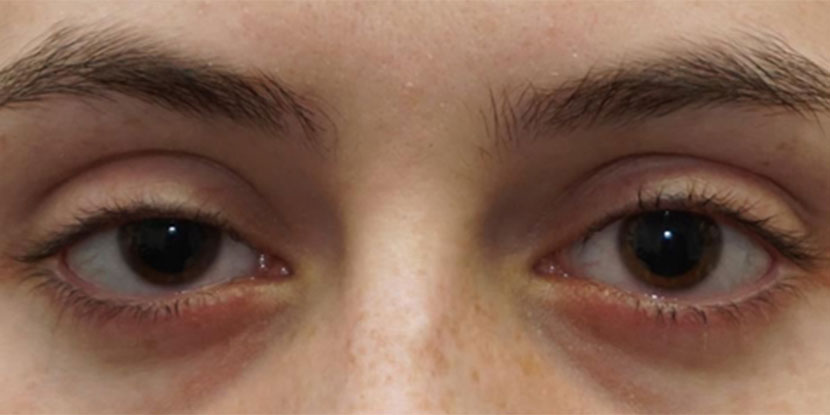 Everything You Need To Know About Droopy Eyelids