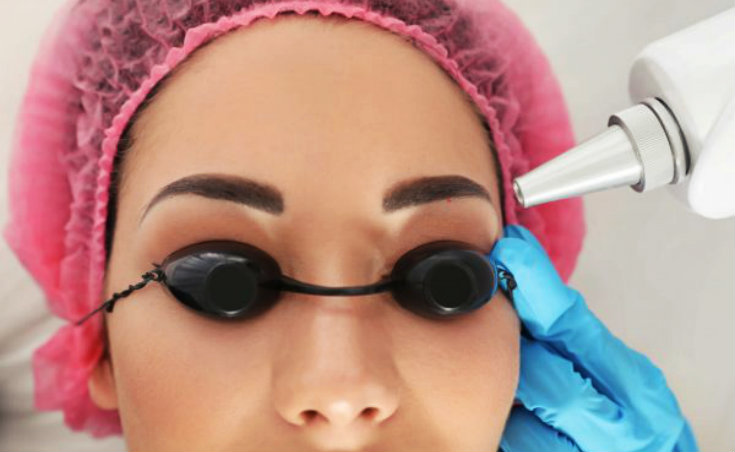 Laser Magic: How Permanent Makeup Removal Works