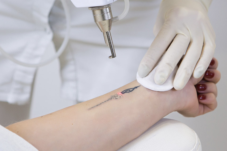 Targeting Ink: Customized Laser Tattoo Removal Solutions